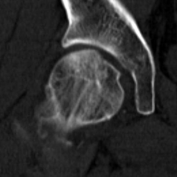 Even if a small osteochondral fragment attached to the ligamentum teres adjacent to the fovea of the femoral head appeared to be avulsed by the ligamentum teres, the main fracture fragment was too