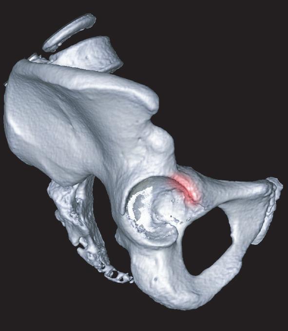 340 The posterosuperior and lateral portions of the femoral head impinge against the anteroinferior margin of the acetabular rim to produce an impaction fracture of the femoral head and occasionally