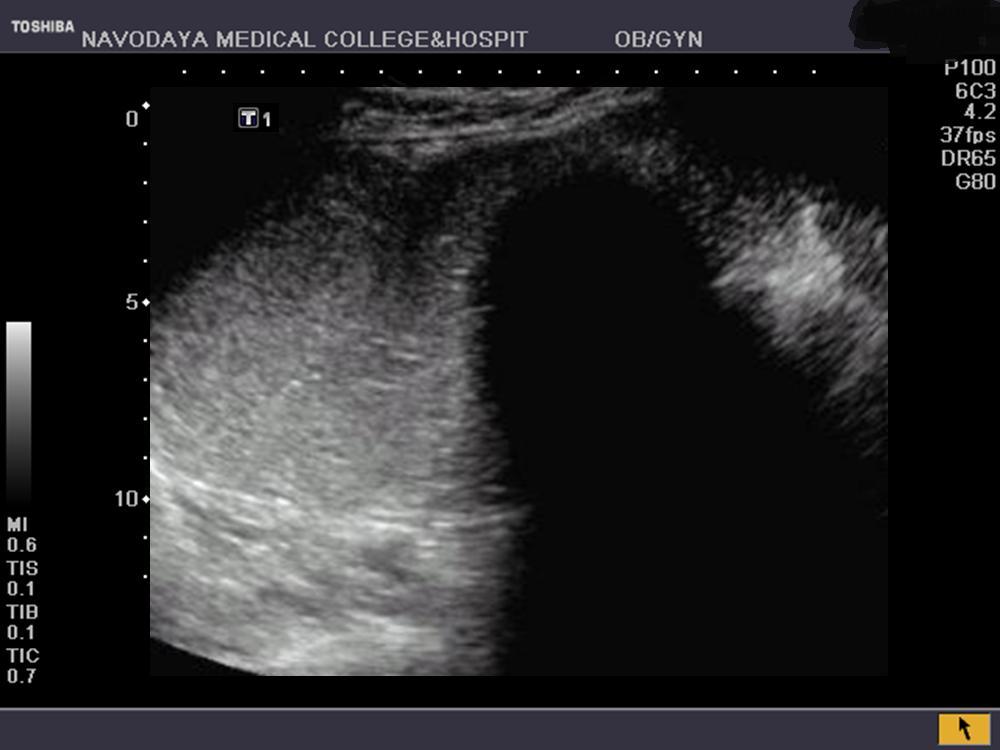 Figure 2: Group IIA - Complex cystic mass with internal solid