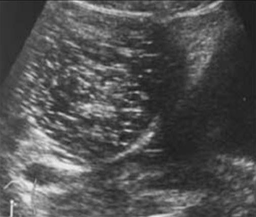 Figure 5a: Group IIC -Cystic mass with multiple