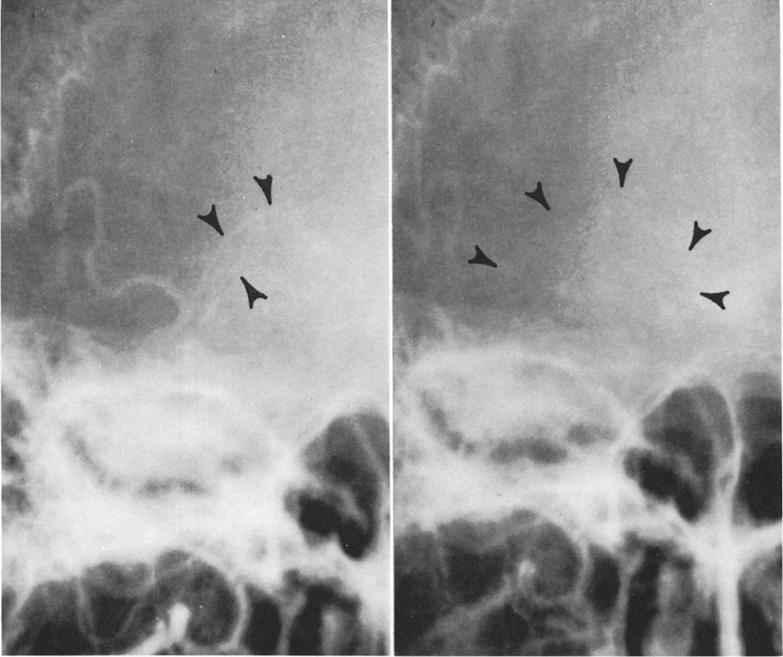 Harvey L. Levine, Ernest J. Ferris and Edward L. Spatz FIG. 3. Case 1. Anteroposterior selective right external carotid angiogram.