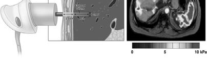 Imaging evaluation of fibrosis in NAFLD Transient elastography (FibroScan) Transient Elastography (FibroScan) Failure of fibroscan BMI > 28 k/m Steatosis Foucher et al.