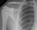 jpg Frontal plane Right Glenohumeral Joint: Frontal Section