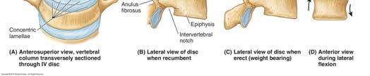 Lumbar Disc Herniation: Usually