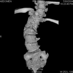 Abnormal development of vertebrae Effects of osteoporosis on the vertebral column Dislocation of cervical vertebrae