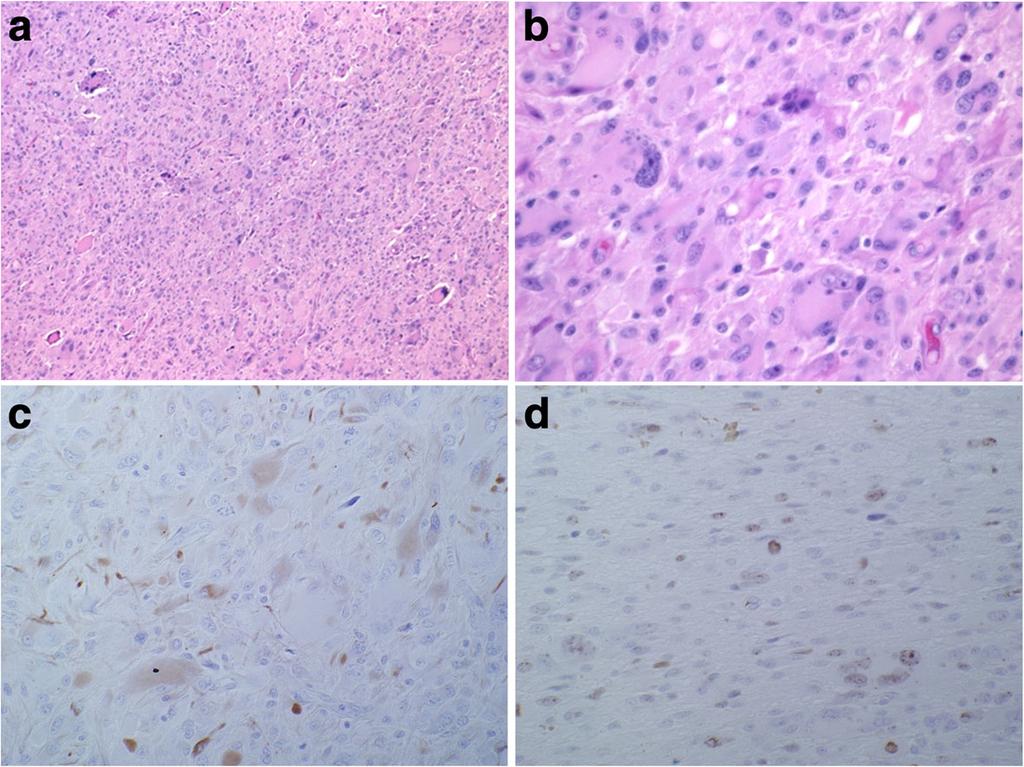 [6] reported a case of a 65-year-old man with anaplastic PXA and spinal leptomeningeal spread at the time of diagnosis.