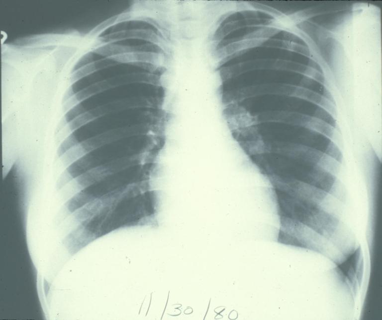 CXR HIV infected persons In HIV-infected persons almost any abnormality on CXR may indicate TB May cause infiltrates