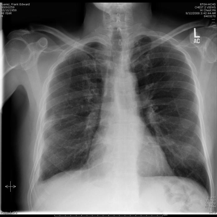 CXR old healed TB Old healed TB nodules & fibrotic lesions have welldemarcated sharp margins Dense nodules, with or without