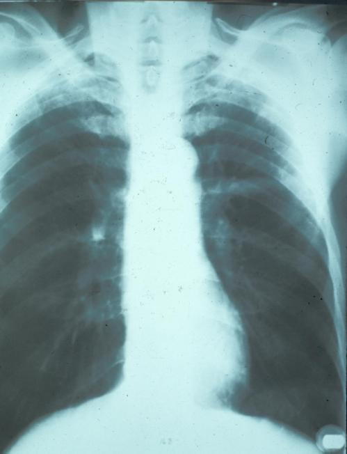 CXR old healed TB Nodules & fibrotic lesions may contain slowly