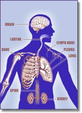 Sites of TB Disease Lungs Extrapulmonary: Larynx Pleural effusion Kidneys Lymphatics Bones & joints Miliary (disseminated) Signs & Symptoms Pulmonary TB Pulmonary
