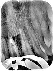 Fig 1 Teeth elicited negative response on thermal as well as Electric Pulp Testing. Hence, diagnosis of Ellis class IV fracture leading to pulpal necrosis was made.