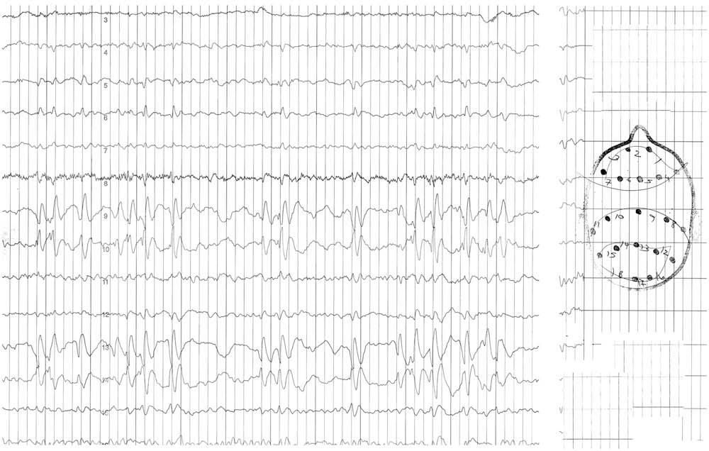 Figure 1. Awake electroencephalographic recording, patient 3. te typical rolandic spikes over the right parasagittal region.