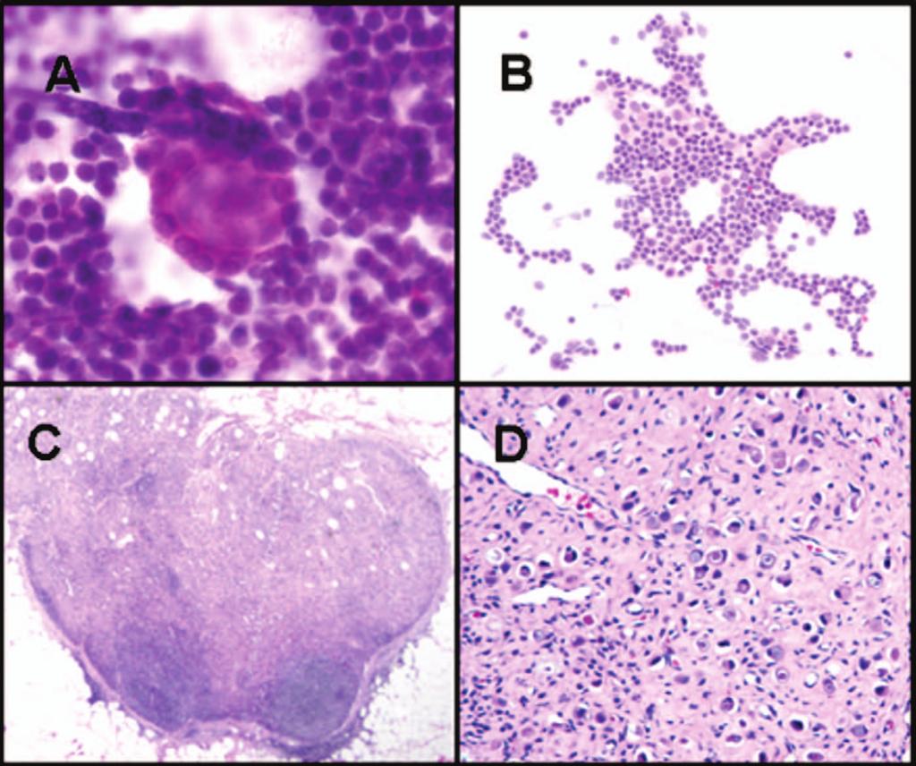 A, Foci of metastatic ductal carcinoma on touch preparations (TPs) following neoadjuvant therapy are typically small, rare, and easily overlooked.