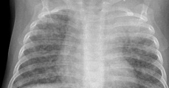 TB Exposure Children < 5 years of age with a negative PPD,