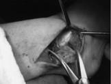 Distal Fibular Window Osteotomy Allen & DiGiovanni, Tech Ft Ankl 2003 Rollback fibular window