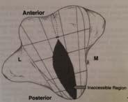 of certain OLT Autologous osteochondral transplantation requires perpendicular access for proper graft placement Need for Perpendicular Access to Talar Dome Soft tissue approaches and/or osteotomies