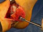 attachment with scissors Anterior capsule has to be released from axilla to the tip of