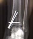 forceps Internal fixation performed with the