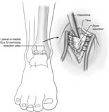 dome DF ankle for most dome exposure Anterior Tibial Plafondplasty Peters et al.