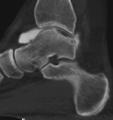 Lateral Access with Osteotomy Transverse osteotomy 1 cm proximal to joint line Incise distal syndesmotic ligaments, retract inferiorly Reduce with lateral plate with syndesmotic screw
