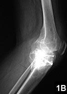 This article describes a patient with a preexisting posttraumatic deformity, patella infera, and end-stage osteoarthritis who required a concurrent TKA and tibia osteotomy to correct the mechanical