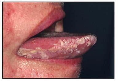 development of oral cancer. One in three lesions will regrow. The chance of reoccurrence is greater with patients who continue to smoke.