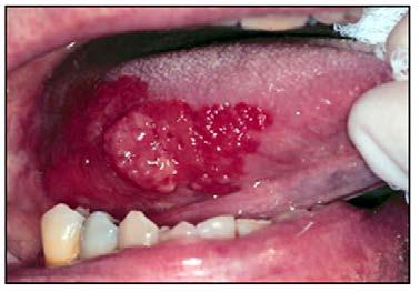 Clinical Significance oral lesions found in tobacco users should be viewed with increased suspicion for possible precancerous or cancerous lesions.