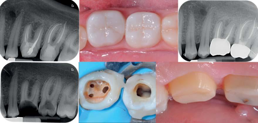 Figure 10: Indirect non-bonded restorations on DME, DMA by means of electrosurgery. Isolation achieved by means of rubber dam and Teflon.
