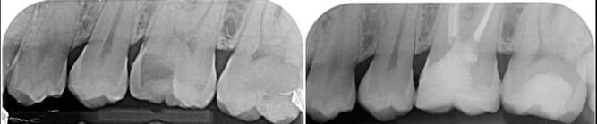 Figure 12: DME and proximal geometry. Pre-op and post-op radiographs.