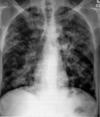 1991 Tuberculosis Technical Instructions: for applicants 15 years of age Inactive TB Chest radiograph No TB Class B2 Active TB No Class Valid for travel within 6 months Valid for travel within 12