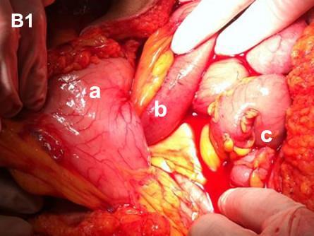Direct signs of intraperitoneal hernias:the local approach of thin small intestine,
