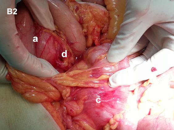 Indirect signs of intraperitoneal hernias:passive shift of surrounding organs caused by