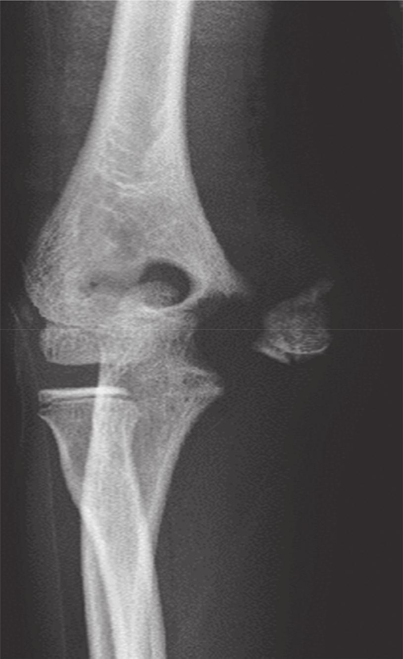 2 CaseReportsinOrthopedics Figure 1: Anteroposterior radiographs of the right elbow at the initial visit. A medial condyle fracture (Kilfoyle type III) was seen.