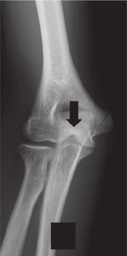 CaseReportsinOrthopedics 3 (a) (b) (c) (d) (e) Figure 4: Follow-up from 1 to 4 years and contralateral anteroposterior radiography.(a) The 1-year follow-up examination.