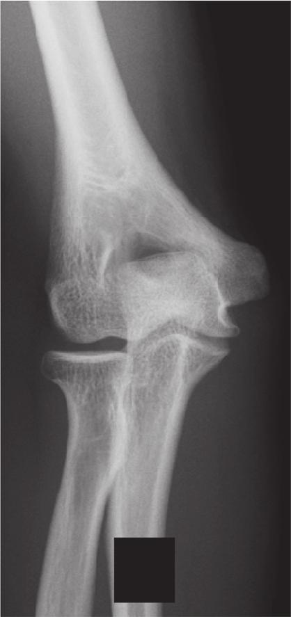 (e) Contralateral anteroposterior radiography.