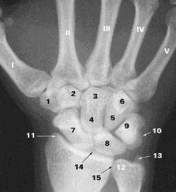 Arthrology of the Wrist Radiocarpal Joint Accepts approximately 80% of the force that crosses the wrist Midcarpal Supporting Structures of the Wrist Joint Intrinsic Ligaments- ate and