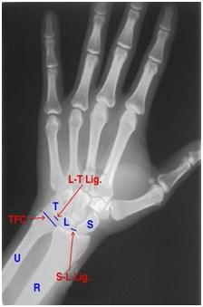 Scaphoid Lunate (S L Lig) Extrinsic Ligaments Radial collateral ligament Crosses wrist laterally to connect radius and carpals Ulnar collateral ligament Crosses wrist medially to connect