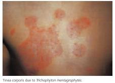 Small lesions occurring anywhere on the body, mainly trunk, legs and arms with a dermatophyte especially on glabrous