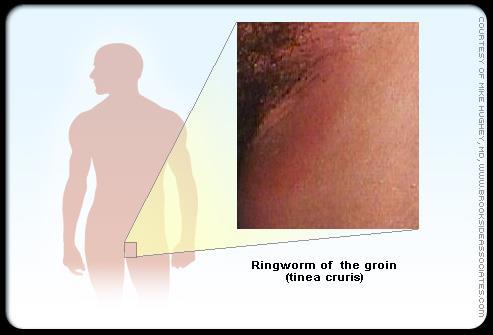 ringworm of the feet. This infection is most commonly produced by T.