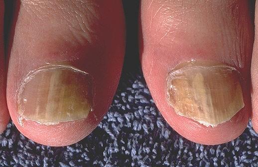 4-Tinea Unguium Tinea unguium, (onychomycosis) a dermatophyte infection of the nail or ring worm of the nails.