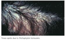 Favus is a distinctive infection with grey, crusting lesions.