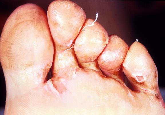 Tinea pedis caused by T.