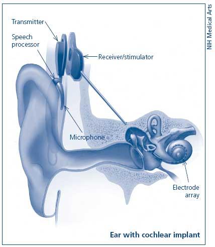 Cochlear Implants Microphone Picks-up sound Speech Processor Converts sound into digital signal NIH Medical