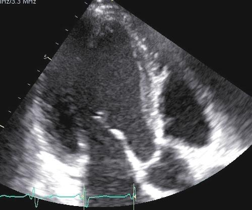 42 year old man with dyspnea What