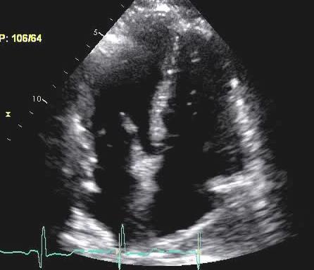 TR is high 2018 MFMER 3712003-5 80 year old man with dyspnea and PHT Cardiac