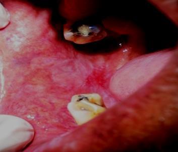The most common site for oral lichen planus was buccal mucosa extending to retro molar area.