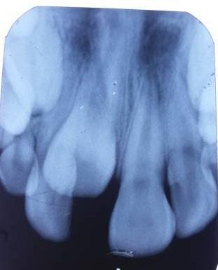 An intraoral examination showed the child in mixed dentition stage with erupted both upper and lower permanent incisors except upper right central incisor.