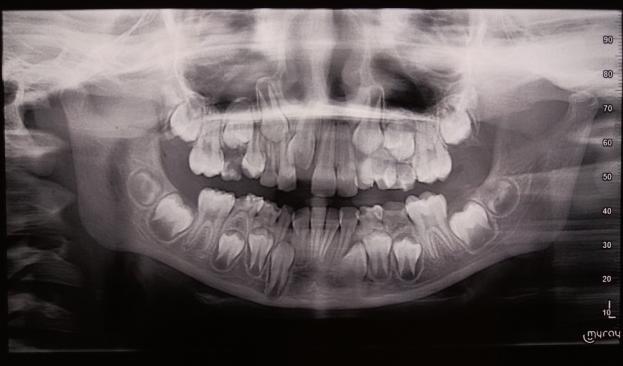 Fig.3: Panoramic radiograph showing ectopically present maxillary right central incisor. Fig.