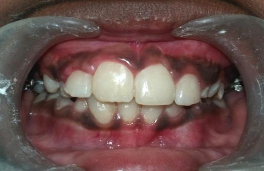 DISCUSSION Impacted maxillary incisor occurs less frequently than the maxillary canine but it brings concerns to the parents in the early mixed dentition because the