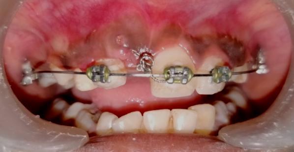 There are several reports of successful treatment of impacted maxillary anterior teeth by proper crown exposure and orthodontic traction.